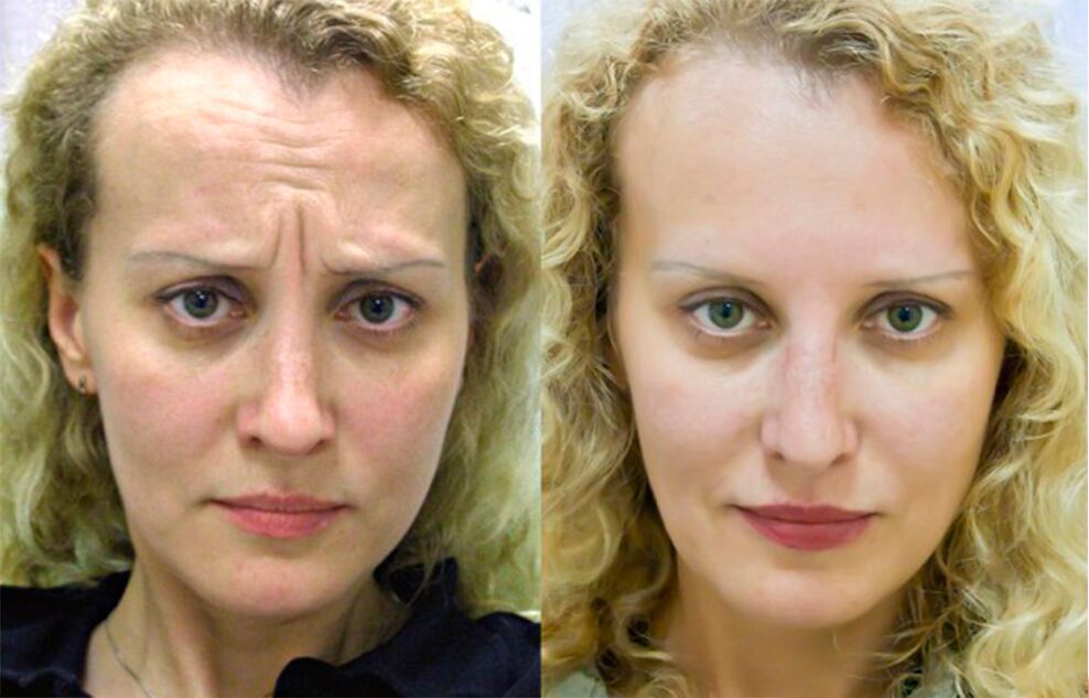 înainte și după utilizarea aparatului de masaj pentru întinerire ltza foto 1