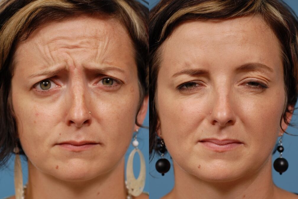 înainte și după utilizarea aparatului de masaj pentru întinerire ltza foto 2