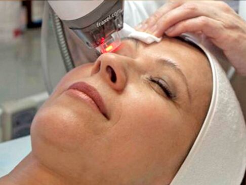 întinerirea cu laser a pielii din jurul ochilor