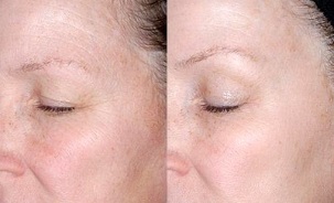 întinerirea pielii din jurul ochilor înainte și după fotografii