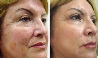 întinerire fracțională a pielii înainte și după fotografii