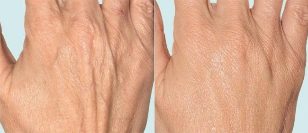Pielea mâinilor înainte și după terapia fracționată