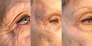 fotografii înainte și după întinerirea pielii în plasmă
