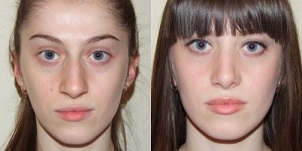 înainte și după întinerirea pielii în plasmă